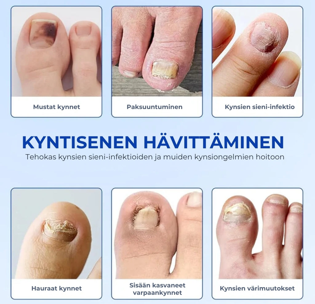 Kynsisienen hoitolaastarit – tehokas hoito terveille kynsille