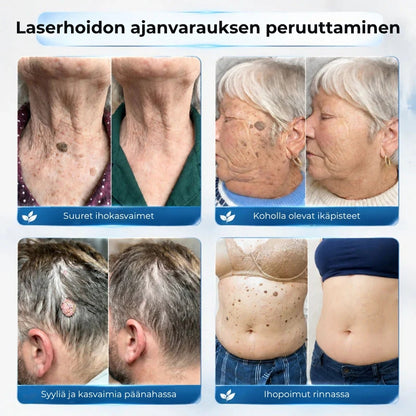 Kohdennettu roll-on syylien ja varsiluomien poistoon