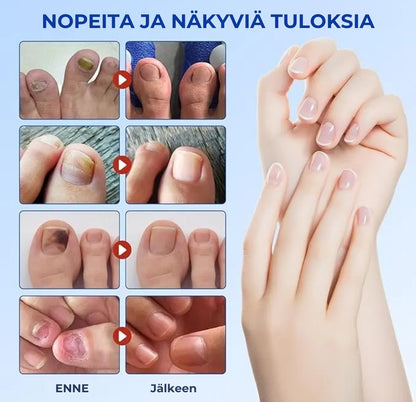 Kynsisienen hoitolaastarit – tehokas hoito terveille kynsille