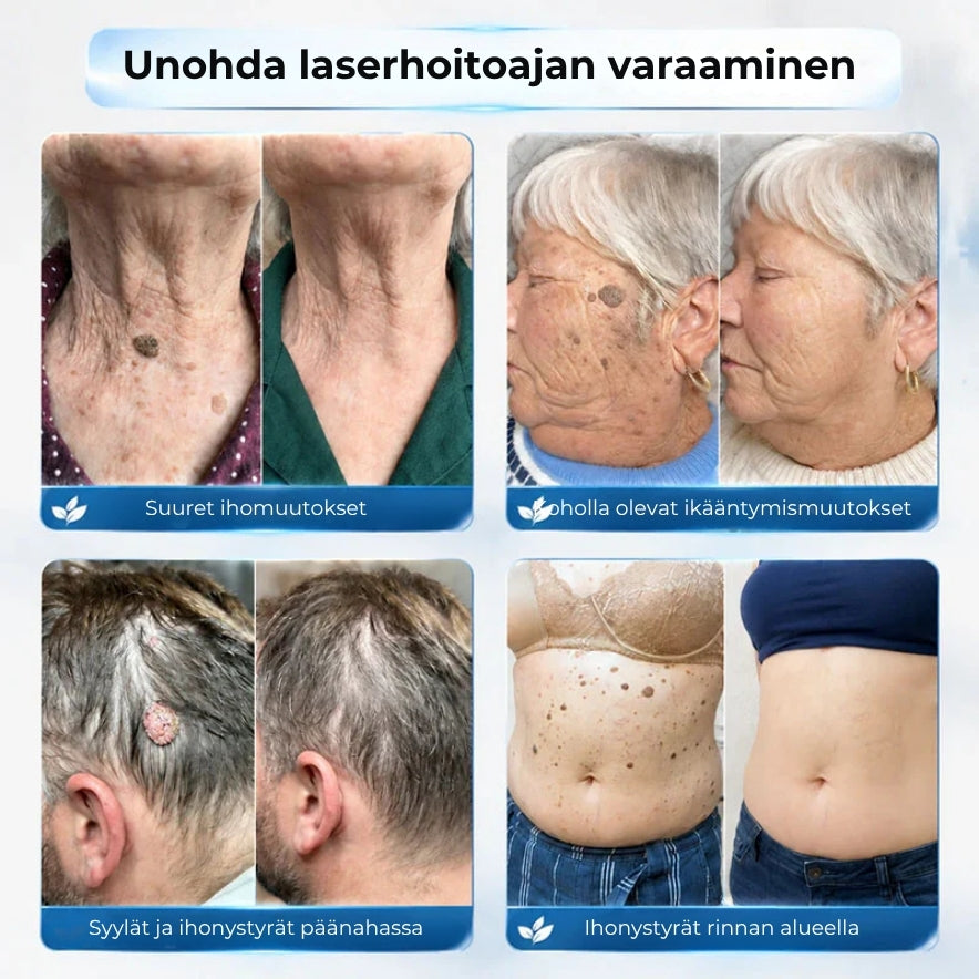 Kohdennettu roll-on syylien ja varsiluomien poistoon