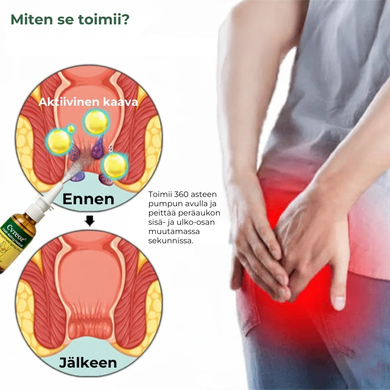 Nopeavaikutteinen yrttisuihke peräpukamien hoitoon